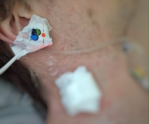 'Babylampje' met ballonnen. En pleister waar plasmaferesekatheter zat.